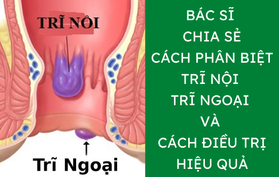 Bác sĩ chuyên khoa chia sẻ cách phân biệt trĩ nội trĩ ngoại và cách