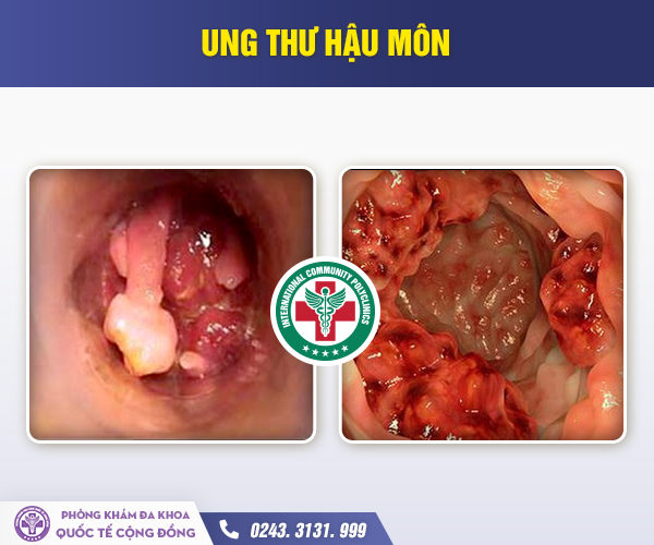 Đại tiện ra máu là dấu hiệu của bệnh gì?